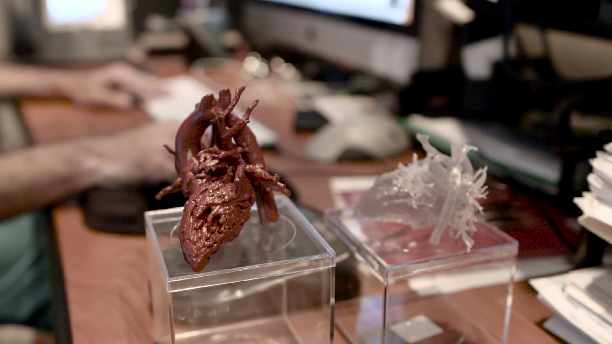 Mia’s 3D printed heart model was created with a Stratasys 3D Printer, enhancing surgical preparedness, reducing complications and decreasing operating time for the surgical team.