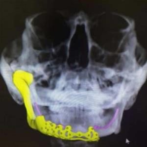 israeli-cancer-patient-receives-3d-printed-jaw-implant3