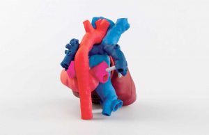 This 3D printed, patient-specific heart model helps surgeons view the patient’s anatomy in 3D, prior to surgery.
